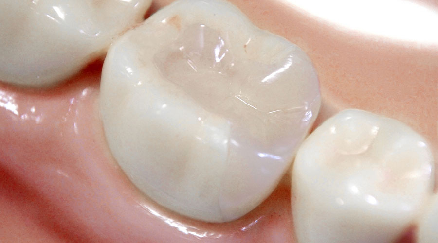 詰め物・被せ物